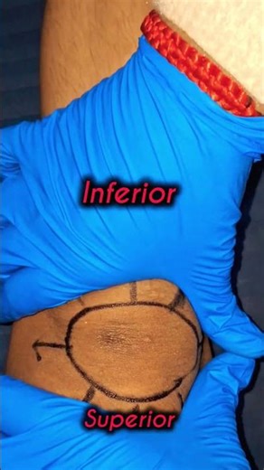 patella Mobilization/glide #physiotherapy #anatomy #physiotherapist #totalkneereplacementsurgery