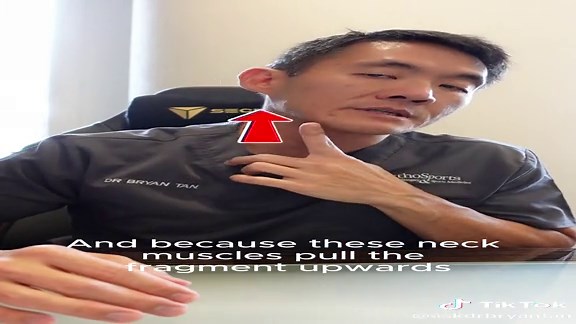 Clavicle Fracture Explained by Dr. Bryan