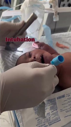 Baby Not Breathing 😱 Doctors Had Seconds to Save Life! #shorts
