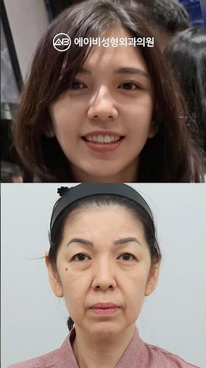 안면거상+중안면부거상+목거상 2달 후기 #shorts