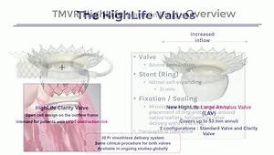 New Staged Mitral Valve Replacement
