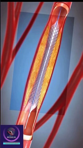 Angioplasty - Carotid Artery Surgery