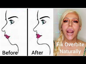 How To Fix an Overbite Naturally Without Surgery | Get Rid of Gorilla Mouth