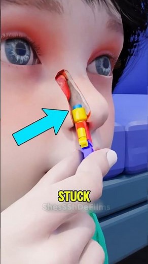 A LEGO Was Stuck Inside His Nose for 26 YEARS... Then This Happened! 😱