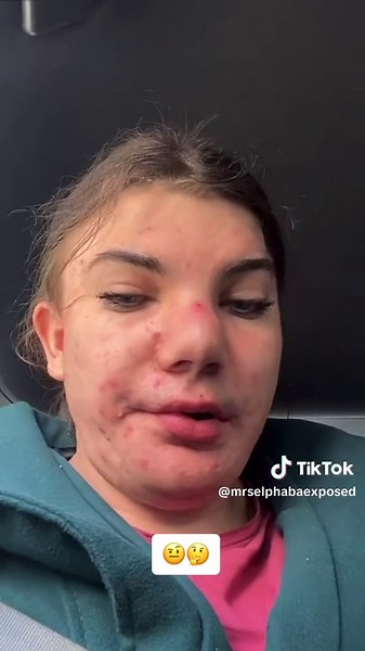 Elphaba Orion Doherty Skin Condition Experience at Primark