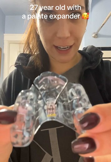 My Adult Orthodontic Journey with a Palate Expander