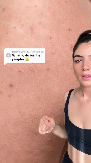 Replying to @Zineb K ✨ #greenscreen how to get rid of ans prevent pimples on your bum and legs