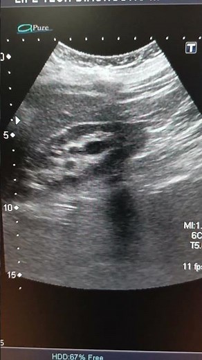 Right ureteric stone and hydronephrosis ultrasound #sonologist #renalcalculi #hydronephrosis