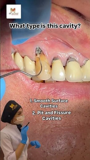 Roots Cavities can we fix it ?