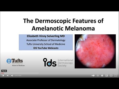 Amelanotic melanoma - Dr. V. Seiverling