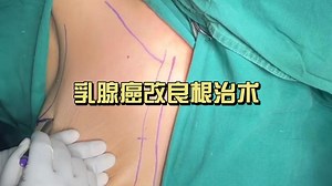 乳腺癌改良根治术（非医学相关专业慎入）