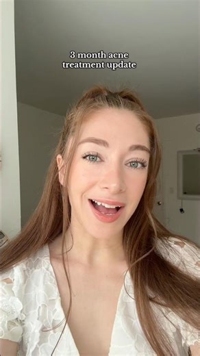 Acne Update | 3 Months on Tretinoin