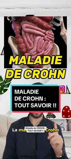Maladie de Crohn : Comprendre les symptômes et traitements