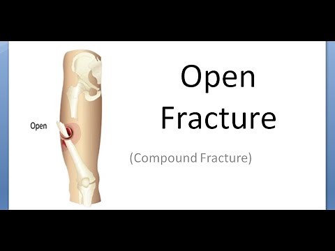 Orthopedics 040 Open Fracture Compound Internal External Manage Modified Gustilo Anderson