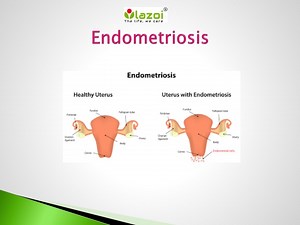 Endometriosis - SlideServe