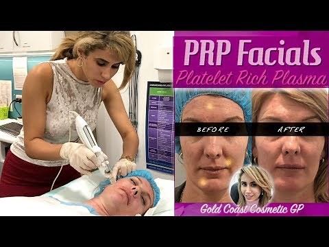 PRP "Vampire" Facials | First Treatment - Before & After - Analysis