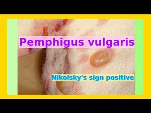 pemphigus vulgaris