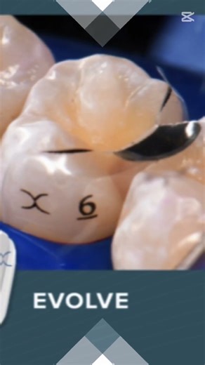 BIOCLEAR 제품들 #바이오클리어 #블랙트라이앵글 #심미치료 #교정후 #소아치과