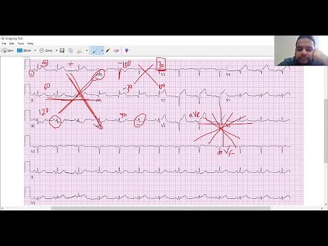 Determining axis of EKG (isoelectric method) practice tracings