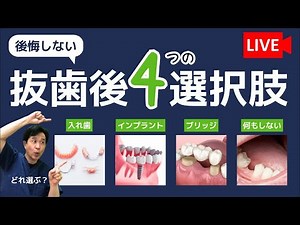 【歯が抜けた時のベストな選択】歯医者がわかりやすく解説します‼︎