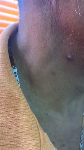 Kussmaul sign. #Kussmaul