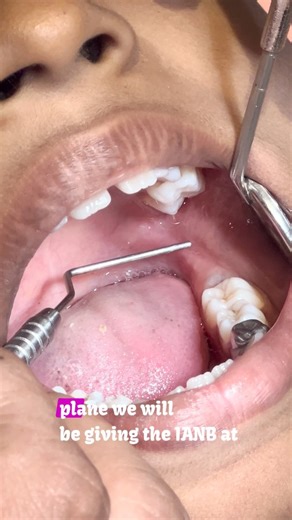 Dr. Ashish Suresh on Instagram: "The basic guide for an IANB! Of all Ages . . Thanks for taking such wonderful videos @dr.bhuvana_natarajan and @khushisethia12 for being the model.. . . #pediatricdentistry #pediatricdentist #dentist #dentistry #kidsdentist #smile #teeth #dental #dentalcare #kidsdentistry #oralhealth #kids #cosmeticdentistry #orthodontics #pedodontist #dentistforkids #pediatrics #dentaloffice #dentalhealth #dentista #dentalhygiene #oralhygiene #familydentist #childrensdentist #ba