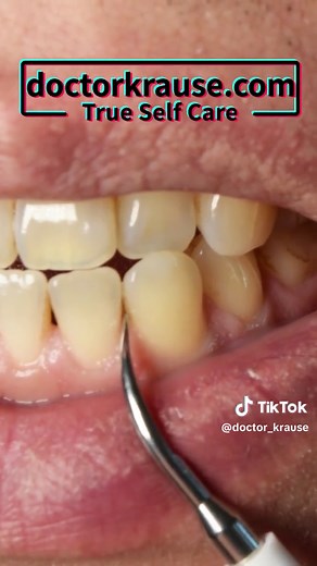 Remove Tartar Stains at Home - Before and After Pictures