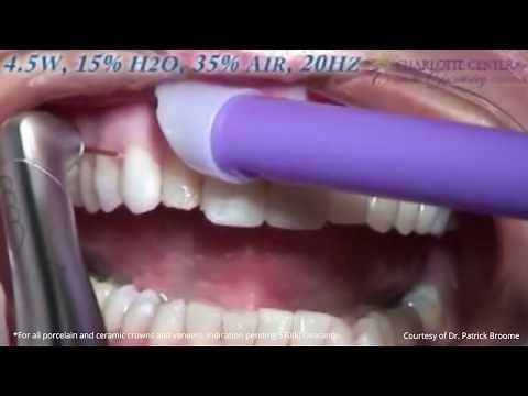 Crown and Veneer Removal - Fast & Easy with Waterlase Laser Dentistry