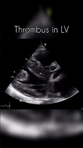 Thrombus in Left Ventricle #echocardiography #echocardiogram How to image