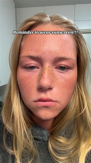 WEAR SUNSCREEN!!! ☀️🥲 #sunburn #pain #neveragain