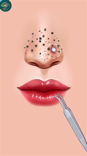 Nose_Blackheads _Removal_ASMR #animation #satisfying #asmr #shortsfeed #relax