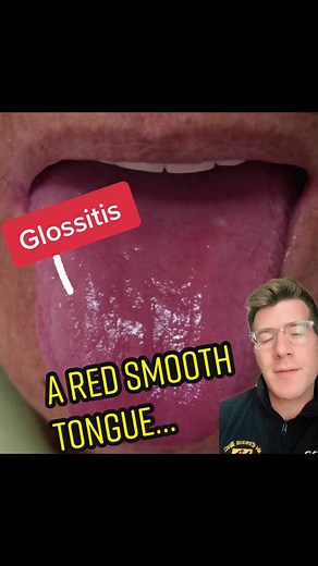 Causes of Glossitis: Vitamin Deficiency and Symptoms Explained
