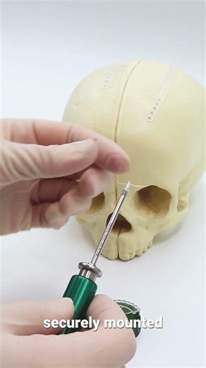 Inion CPS™ and CPS™ Baby: Screw Picking and Insertion Technique