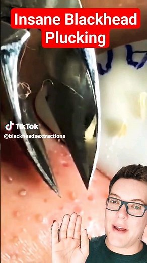Awful BLACKHEAD PLUCKING - Blackhead Removal Fail #shorts