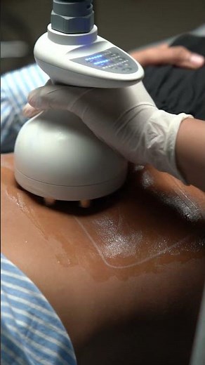 Tighten Loose Belly Skin After Weight Loss with Venus Tummy Tite – Free Consultation#Aesthetics