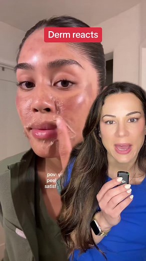 Chemical Peel Journey Reaction and Results with Dermatologist