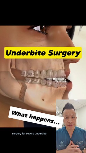 Underbite Surgery: Correcting Severe Underbite for Jaw Alignment