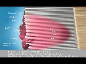 Prospec™ MI Paste and MI Paste Plus™