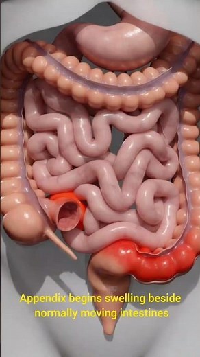 The First Internal Sign That the Appendix Is Becoming Inflamed