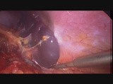 Laparoscopic Splenectomy for a Giant Splenic Cyst • Video • MEDtube.net