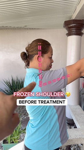28K views · 268 reactions | Precision in assessment unlocks the tailored formula for treating frozen shoulder, ensuring targeted and effective care. #frozenshoulder #frozenshouldertreatment #fypシ゚ | Physical Therapy Session | Facebook