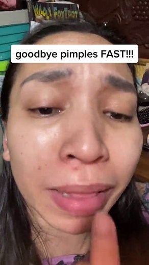 Katialis for Pimples: Affordable Acne Treatment Review