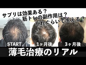 【本当に効果のあるハゲ治療】3ヶ月で結果を出した経験者に聞くAGA治療