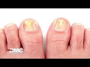 What is toenail fungus?