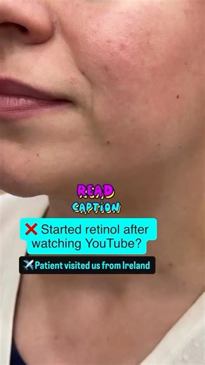 Retinol Damage Is Real | Patient From Ireland | Retinoid-Induced Rosacea| MD Dermatologist Warning