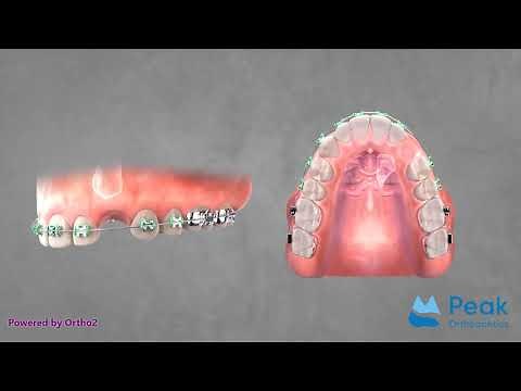 Impacted canine - gold chain