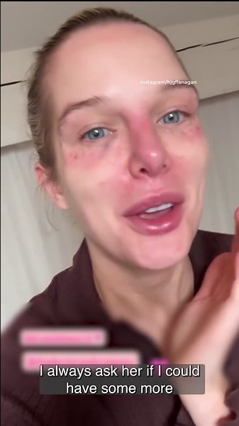 Helen Flanagan shows off painful bruising after her £500 filler