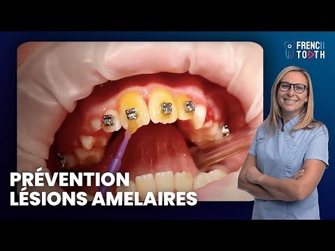 Prévention lésions amelaires en Orthodontie avec vernis fluoré Duraphat - Dr Médio