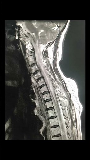 Syringomyelia, or a syrinx, is a neurological disorder where a fluid-filled cyst develops in cord