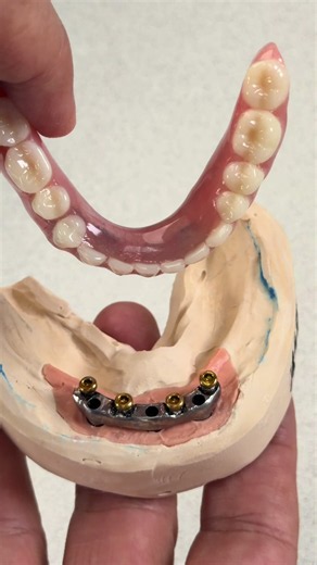 Denture with Locators Completed for Dr. James Jones